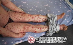 寻常型银屑病能跑步出汗吗？专家详解：实用技巧分享