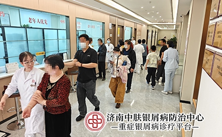 济南红皮病型银屑病诊疗-济南中肤医院 济南红皮病型银屑病诊疗-济南中肤医院
