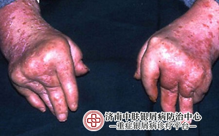 银屑病关节炎1