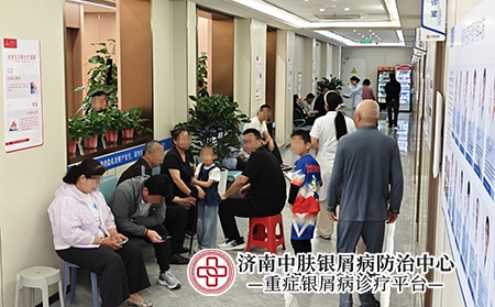 济南关节病型银屑病专家-济南中肤医院 济南关节病型银屑病专家-济南中肤医院